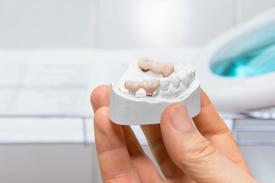 Dental bridge figure