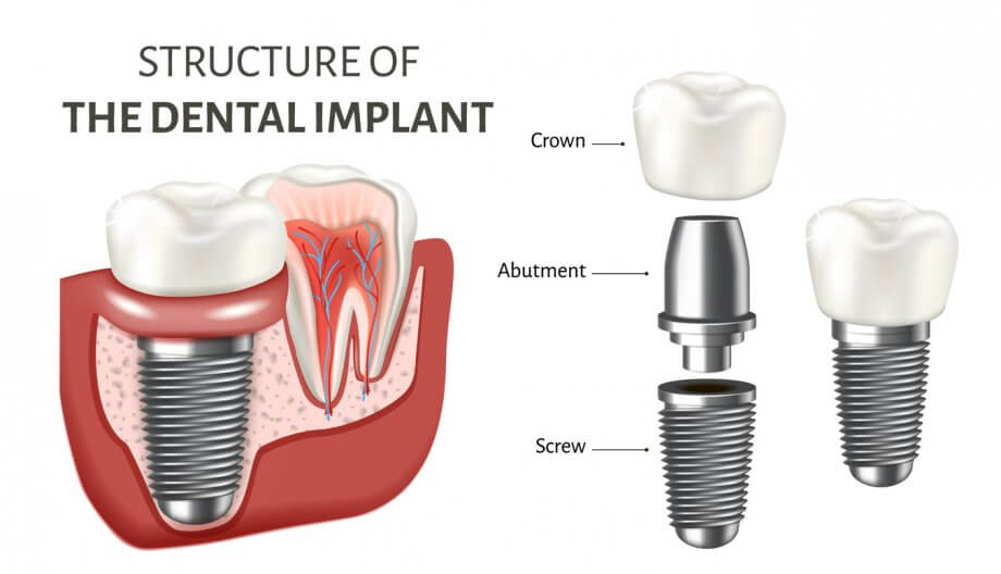 Dental implant and crown graphic