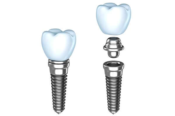 illustration of what a dental implant looks like