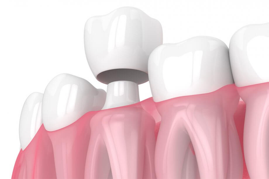 digital rendering of a dental crown