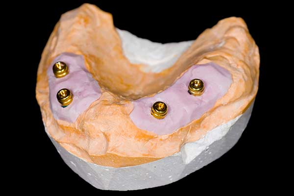Full Arch with All-on-4 Implants in Carmel, NY