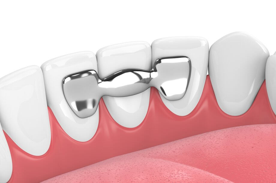 How Long Does It Take For A Dental Bridge To Settle?
