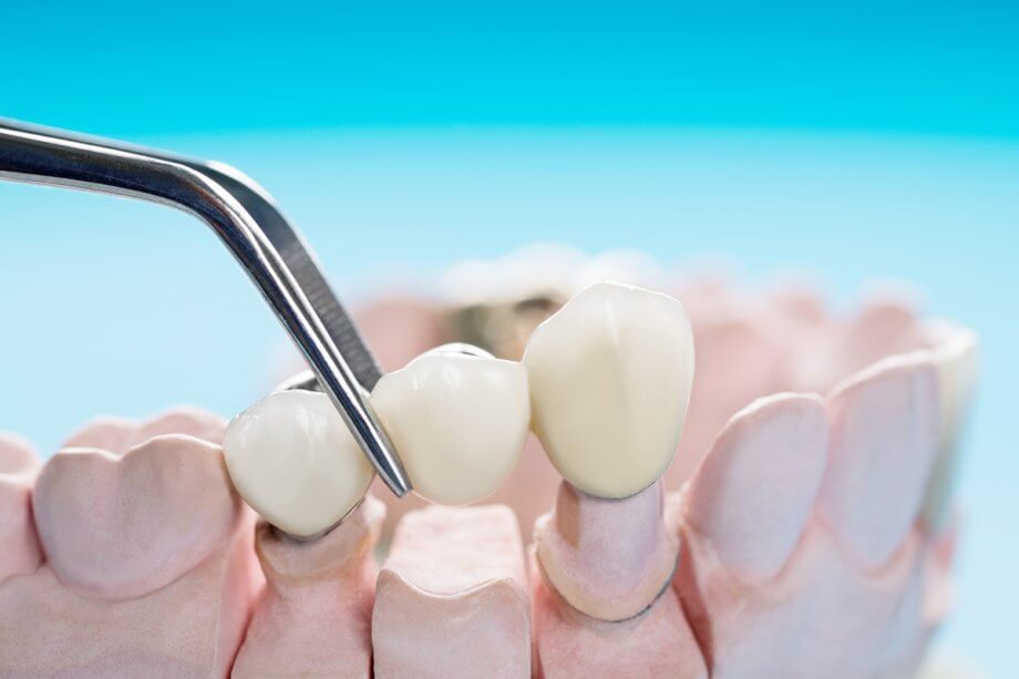 How To Clean A Dental Bridge?