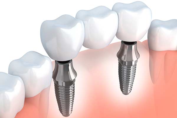 illustration of what an implanted bridge looks like in the jaw