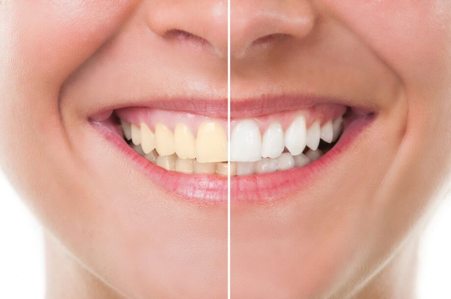 before and after picture of woman smiling after teeth whitening