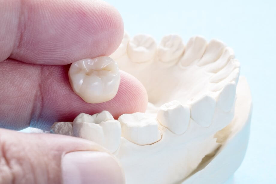 What are Dental Crowns Made Of?