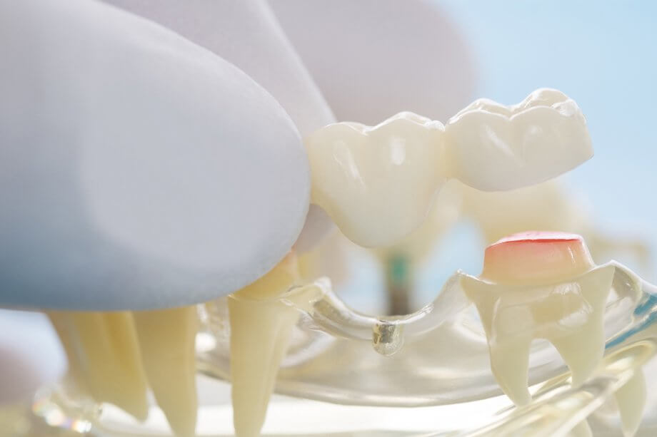 model of a dental bridge